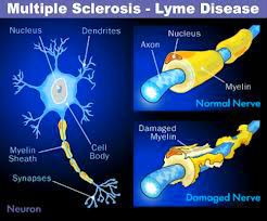 Lyme Brain Defined