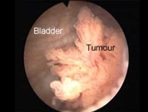 Persistent UTIs may Indicate Bladder Cancer